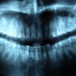 Cirurgia de Extração dos Molares