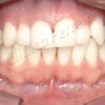 Tratamento de Clareamento Depois