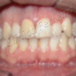 Tratamento de Clareamento Antes