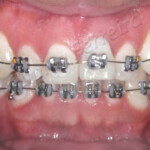 Aparelho Fixo Estético em Safira