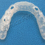 Placa de Silicone com Perfuração por Bruxismo