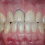 Tratamento Reabilitação com Protese de Porcelana Final