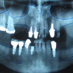 Reabilitação com Implantes Final