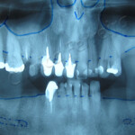 Reabilitação com Implantes Inicial