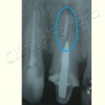 Retratamento Endodôntico Inicial