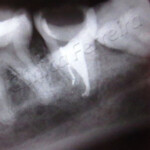 Tratamento Endodôntico Final