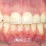 Tratamento Reabilitação com Protese de Porcelana Final